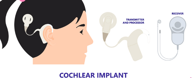 cochlear implants in Delhi