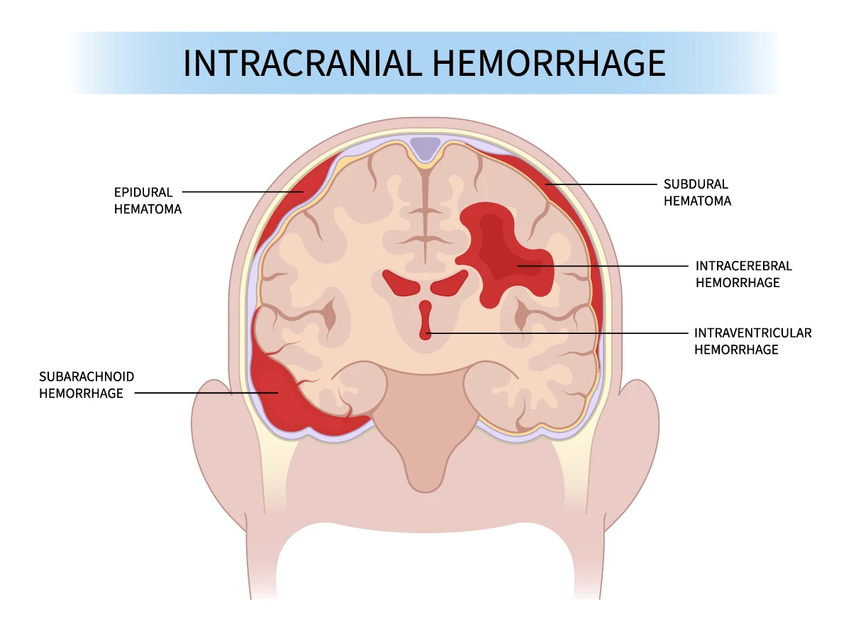 How to Treat Intracerebral Hemorrhage: Options and Outcomes